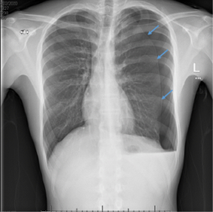 Spontaneous Pneumothorax British Association Of Paediatric Surgeons