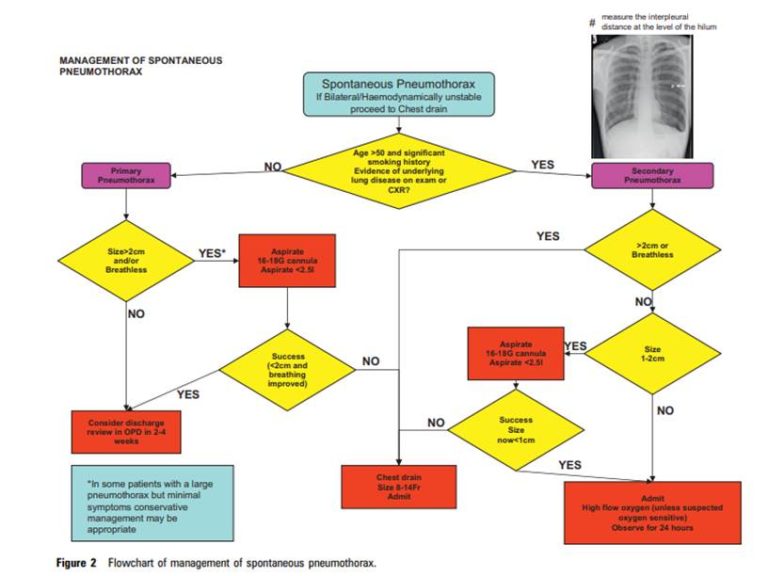 Spontaneous Pneumothorax British Association of Paediatric Surgeons