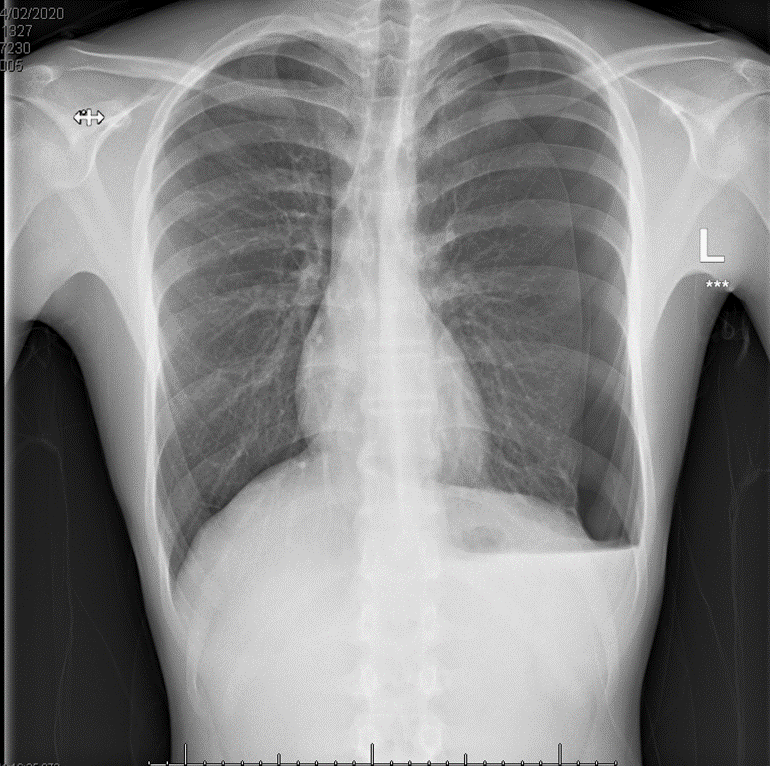 Pneumothorax Lateral View