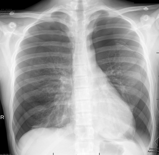 Spontaneous Pneumothorax | British Association of Paediatric Surgeons