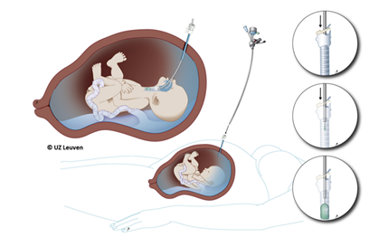 FETAL SURGERY ( FETO ) FOR CONGENITAL DIAPHRAGMATIC HERNIA | British ...